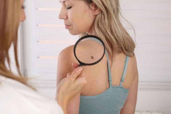 What Are Traditional Skin Lesion Removal Methods Wokingham?