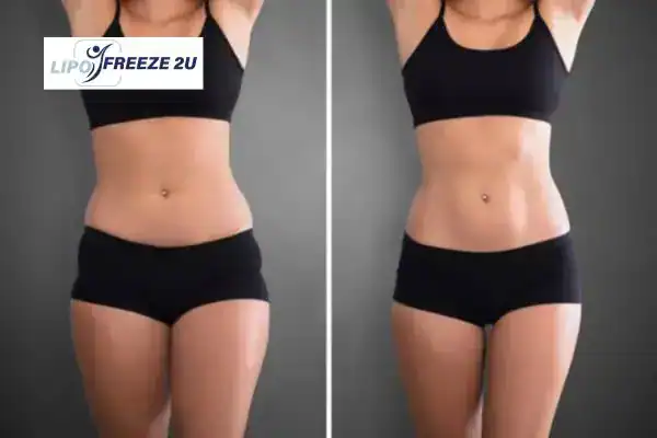 How Can LIPO FREEZE 2U Support Your Post-Pregnancy Body Recovery Wokingham?