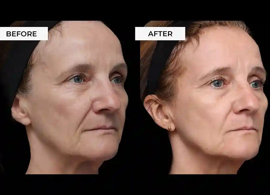 How Many RF Microneedling Sessions Will You Need to See a Difference Wokingham?