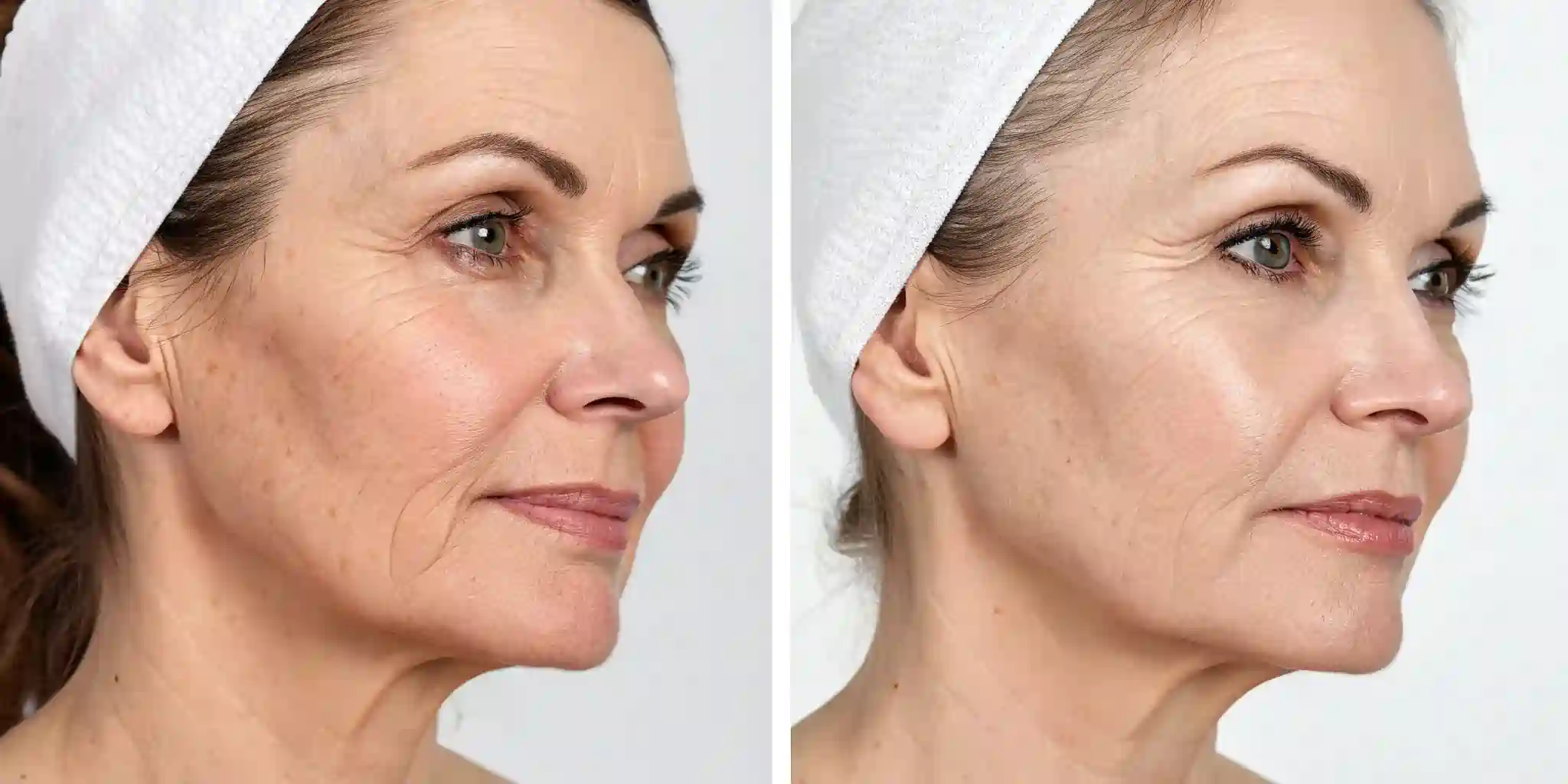 Common Questions About RF Microneedling and Loose Skin Wokingham