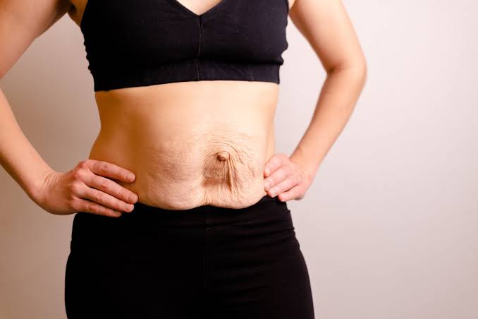 Is Surgery Really the Only Way to Repair Diastasis Recti Wokingham?