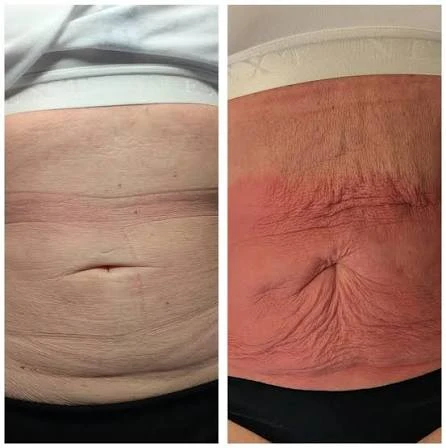 How Does RF Microneedling Improve Crepey, Thin and Uneven Skin Texture Wokingham?