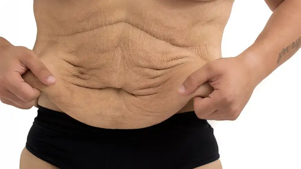 RF Microneedling for Loose Skin: How Can It Help Tighten and Reshape the Skin Wokingham?